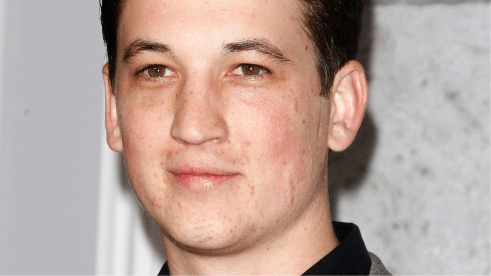 miles teller scars gone