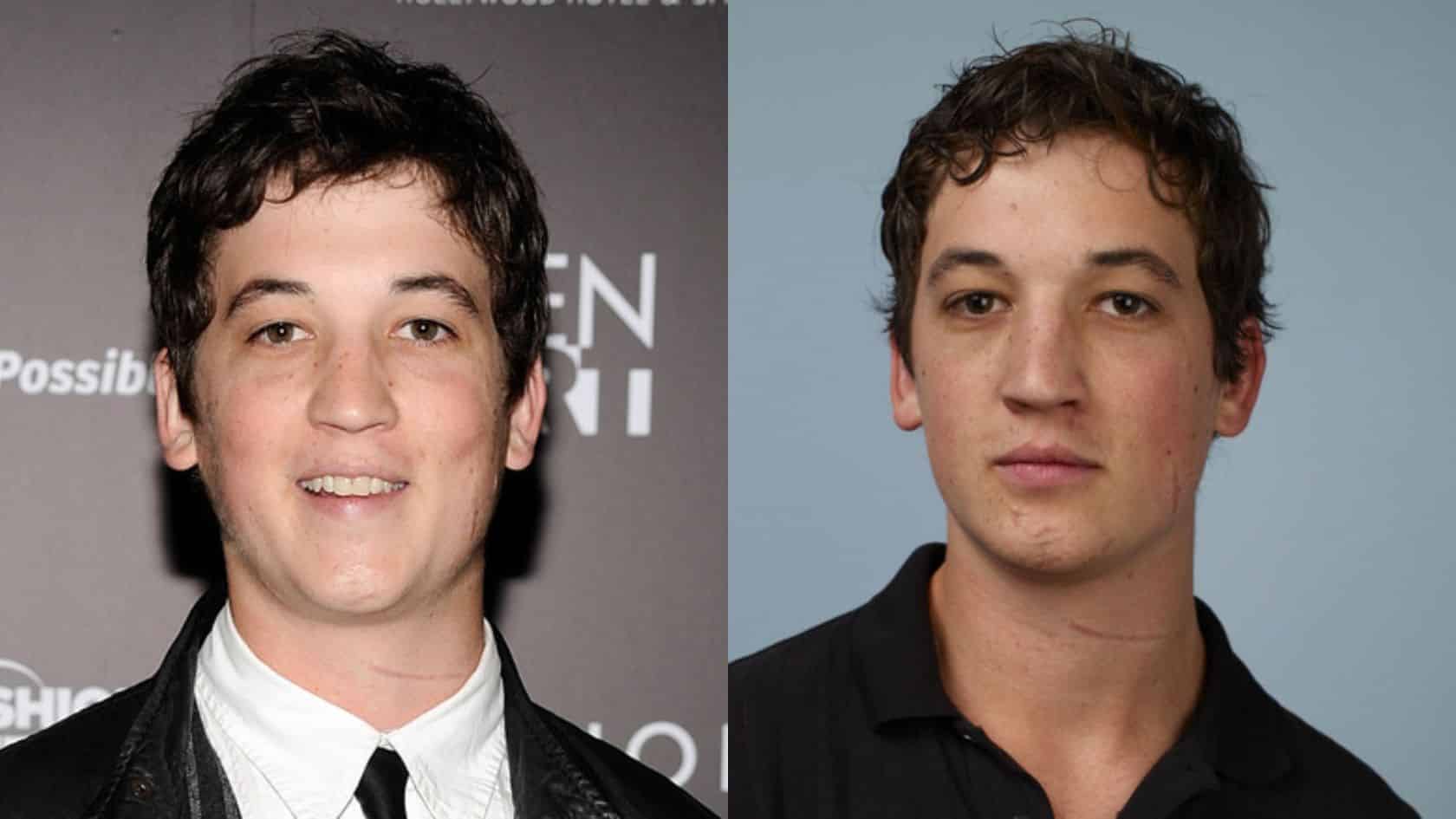 side by side headshots of miles teller with visible facial scars, shown at a red carpet event and in a studio portrait.