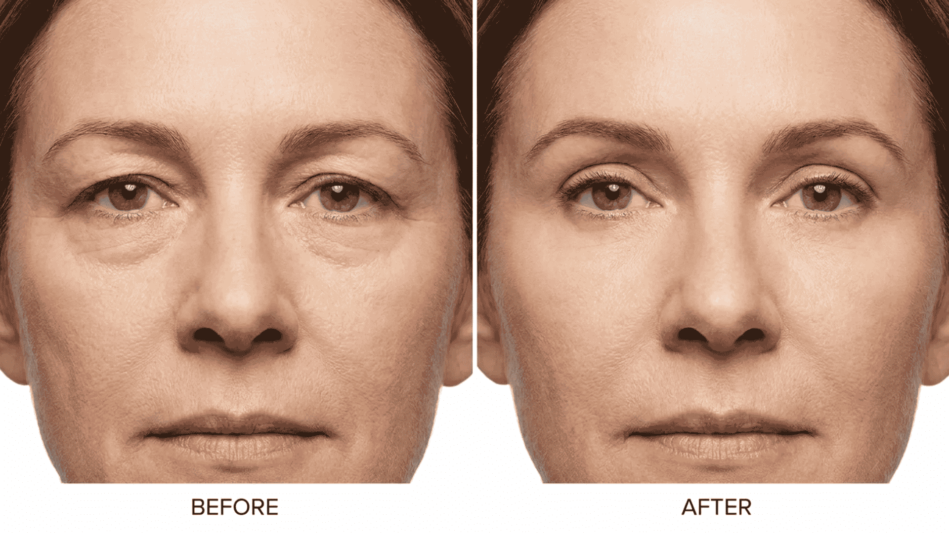 Side-by-side blepharoplasty before and after photo showing realistic eyelid and under-eye
