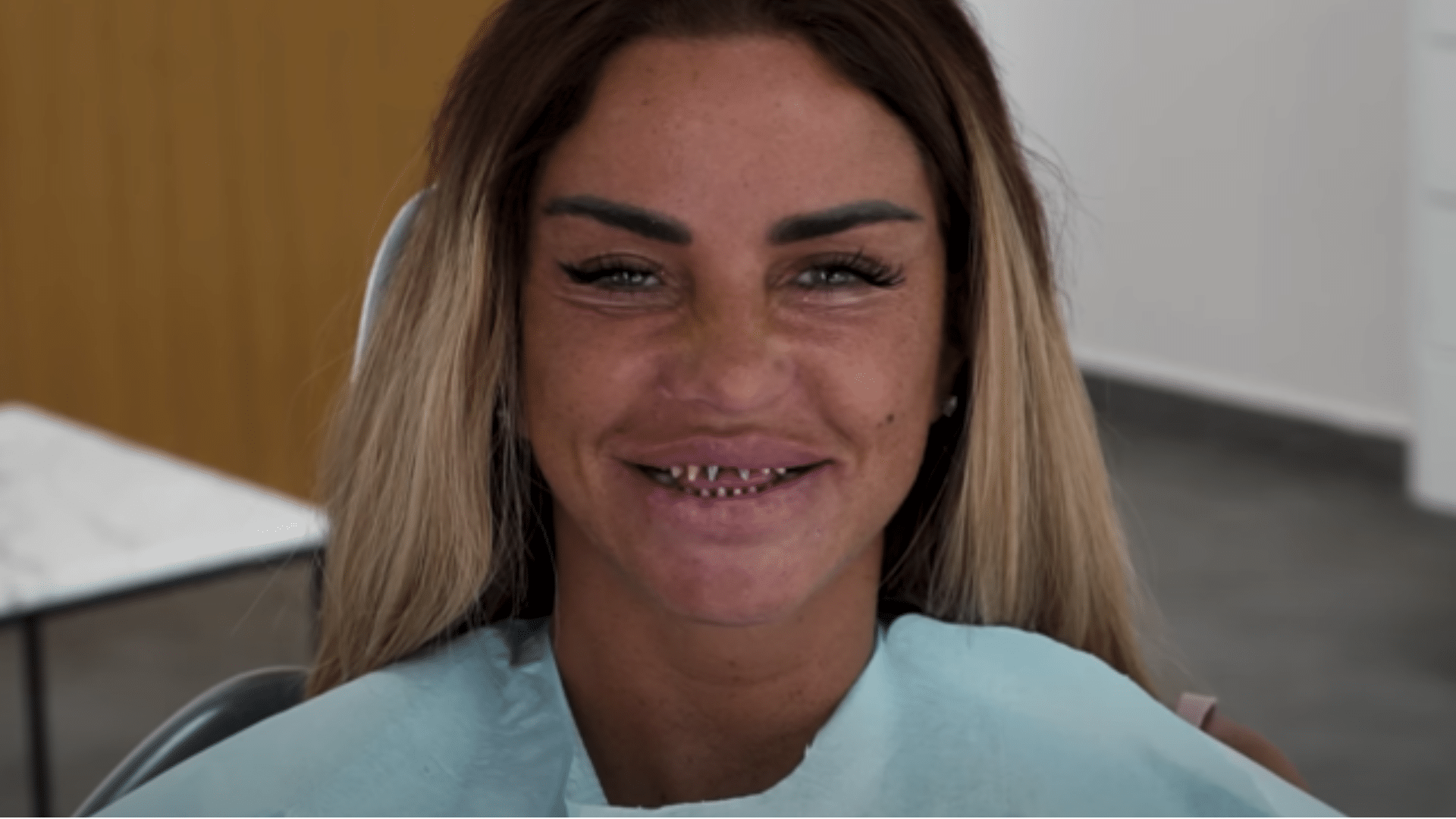 Close-up of Katie Price’s smile showing severely misaligned and damaged teeth, highlighting cosmetic dental issues prior to corrective veneers or dental work.