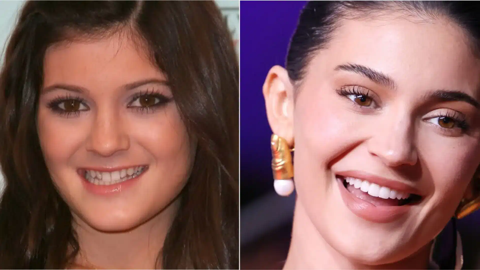 Side-by-side comparison of Kylie Jenner’s smile before and after cosmetic dental work, showing a noticeable transformation