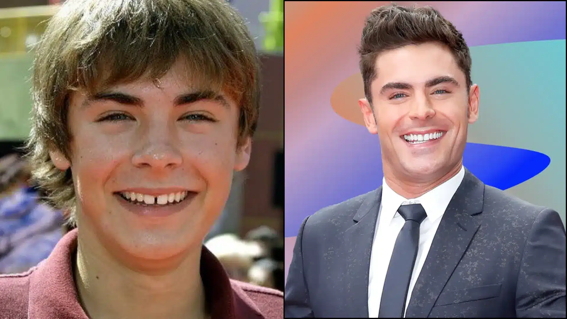 Side-by-side comparison of Zac Efron’s smile, showing his teeth transformation from slightly crowded and off-white to straight