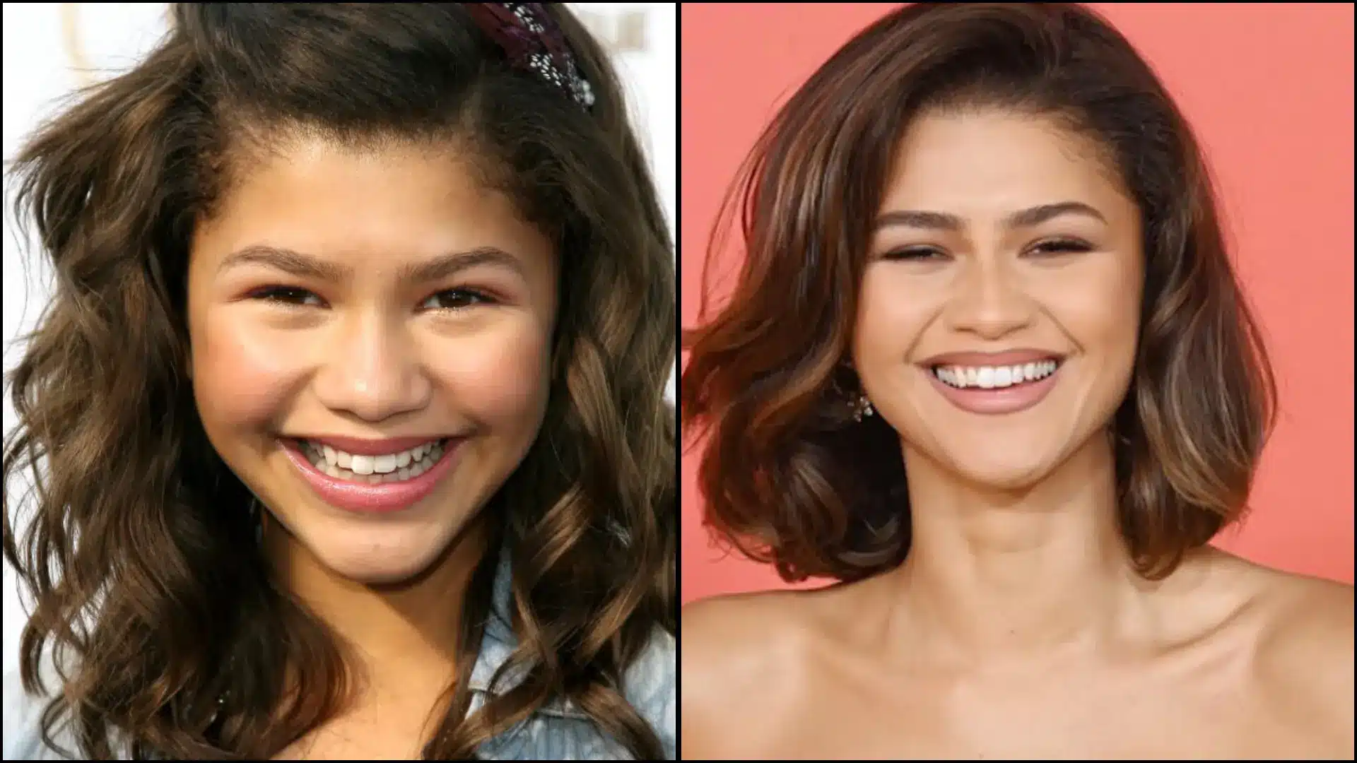 Close-up of Zendaya’s smile showing her teeth transformation, with bright, even, and naturally symmetrical teeth