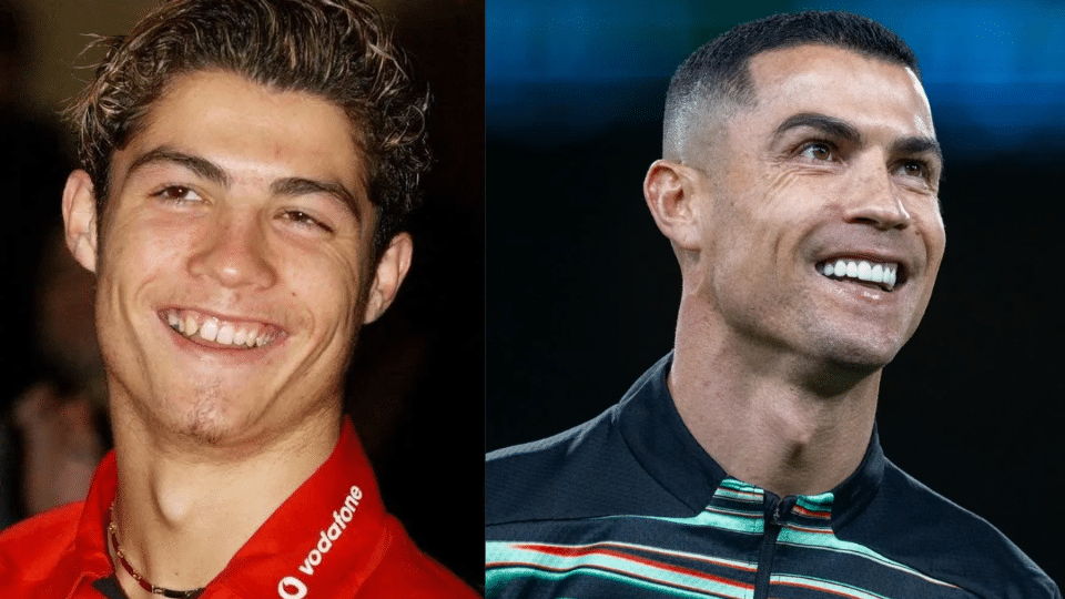 Cristiano Ronaldo before and after dental work, showing his smile transformation with straight, white porcelain veneers.
