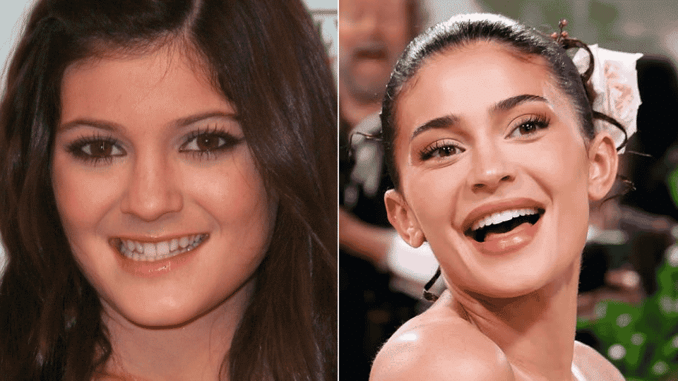 Kylie Jenner before and after dental transformation, showcasing her corrected front incisors and proportional smile.