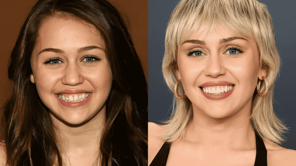 Before and after teeth transformation showing dental smile improvement and enhanced whitening results.