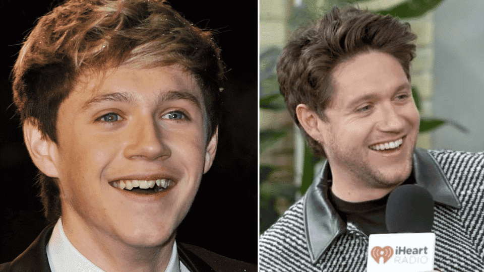 Niall Horan before and after orthodontic treatment, showing his straight and uniform smile correction.