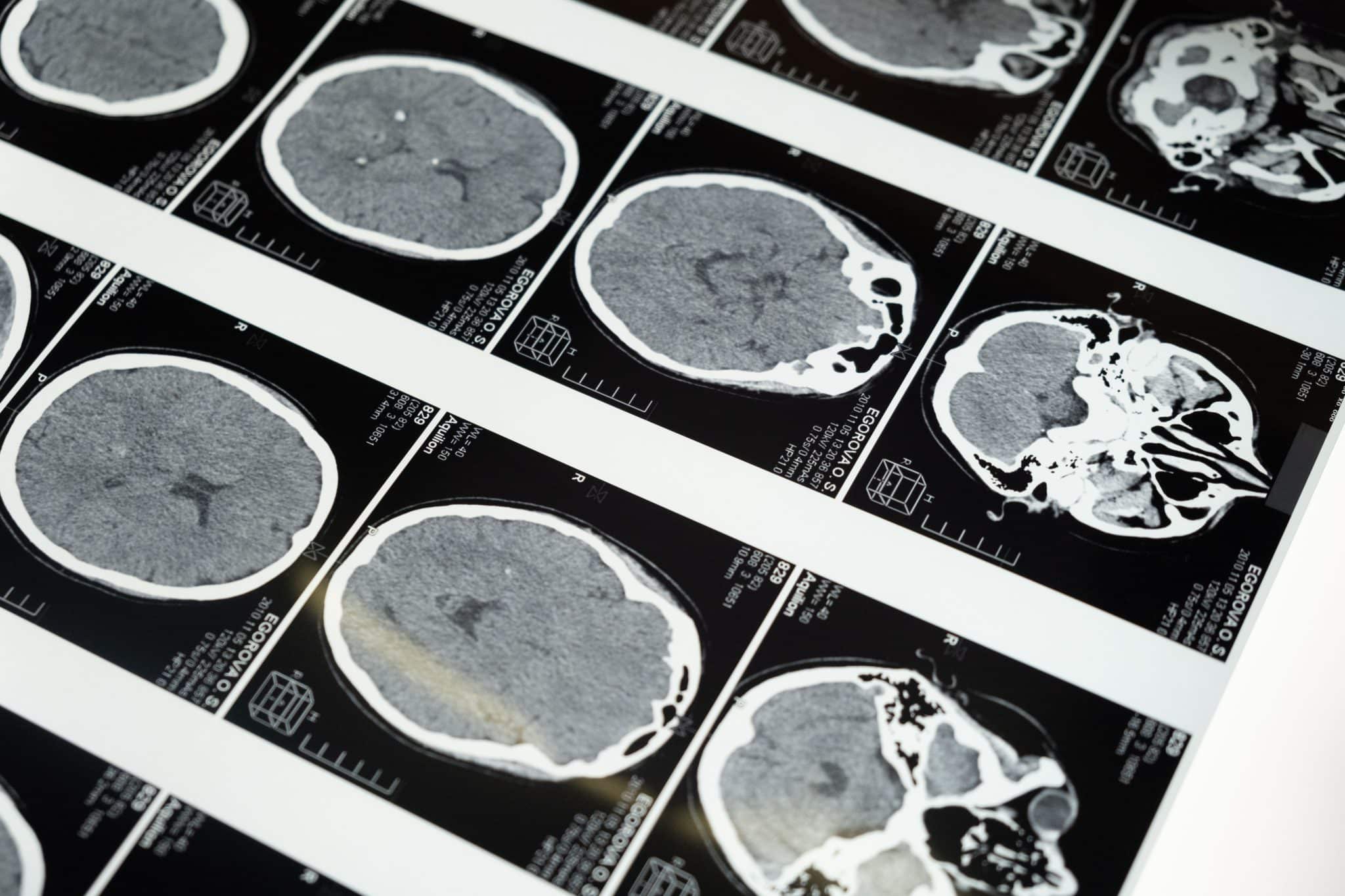 Why a Normal CT Scan After a Fall Can Lie: The Symptom-Free Window That Isn't Actually Safe